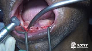 Lower over denture new root form