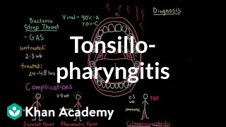 Tonsillopharyngitis - Complications, diagnosis, and treatment | NCLEX-RN | Khan Academy