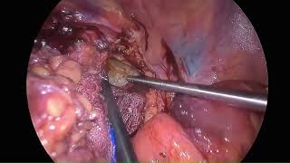 Asvide: Laparoscopic anterior resection for complex sigmoid diverticulitis with the difficult...