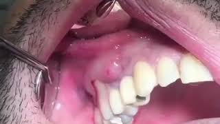 Popping a Tooth Abscess