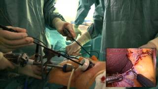 Laparoscopische resectie van de galblaas - Dr. Tom Feryn