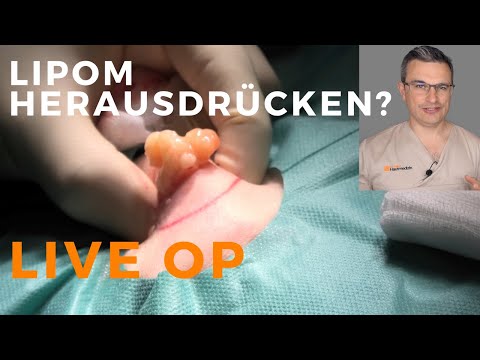 Lipom entfernen in Mainz