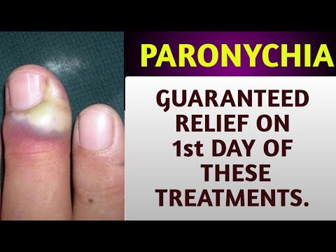 Nail Infection (Paronychia) - Cause & Treatment | नाखून संक्रमण का इलाज  कैसे करें? (Dr. Puspendra) - YouTube