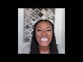 New teeth $3000  Veneers By Dr. Omar Dental Emporium in Dominican Republic