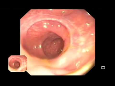 Normal End to End Anastomosis (eea) Stapled Colo-rectal Anastomosis