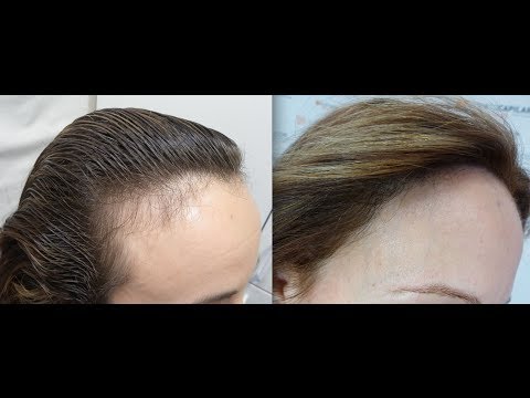1401 FU's. Hair Transplant by FUE Technique. Forehead reduction. Injertocapilar.com. 812/2012