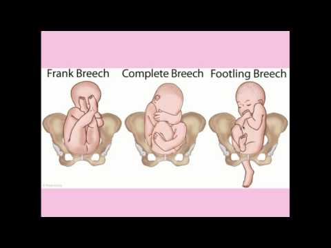 Normal Labor and Delivery - CRASH! Medical Review Series