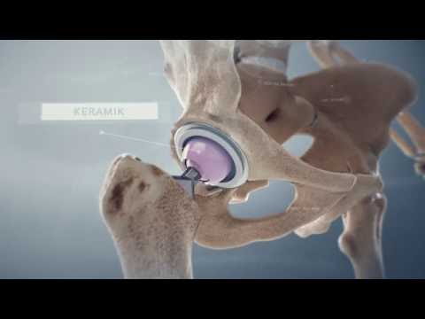 «Hüftprothese» - Schulthess Klinik