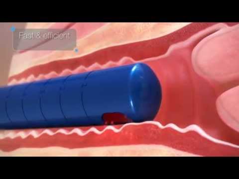 FemTouch™ Vaginal Laser| The SHAW Center - Scottsdale AZ | Lawrence W. Shaw MD