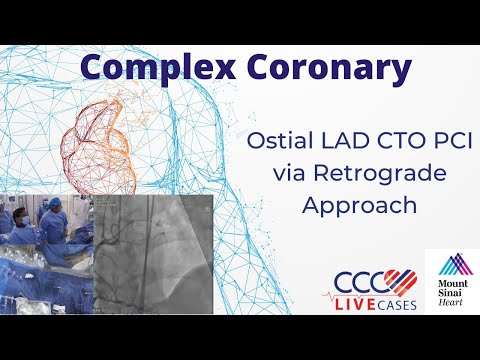 Ostial LAD CTO PCI via Retrograde Approach
