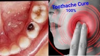 How to relief cavity pain permanently | HOW TO CURE TOOTHACHE PERMANENTLY AT HOME NATURALLY