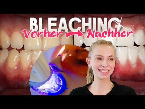 Teeth whitening (bleaching) | The complete process | Consultation + treatment & results