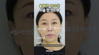 울쎄라 성형 시술