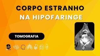 ENGOLIU A DENTADURA - Corpo Estranho na Hipofaringe