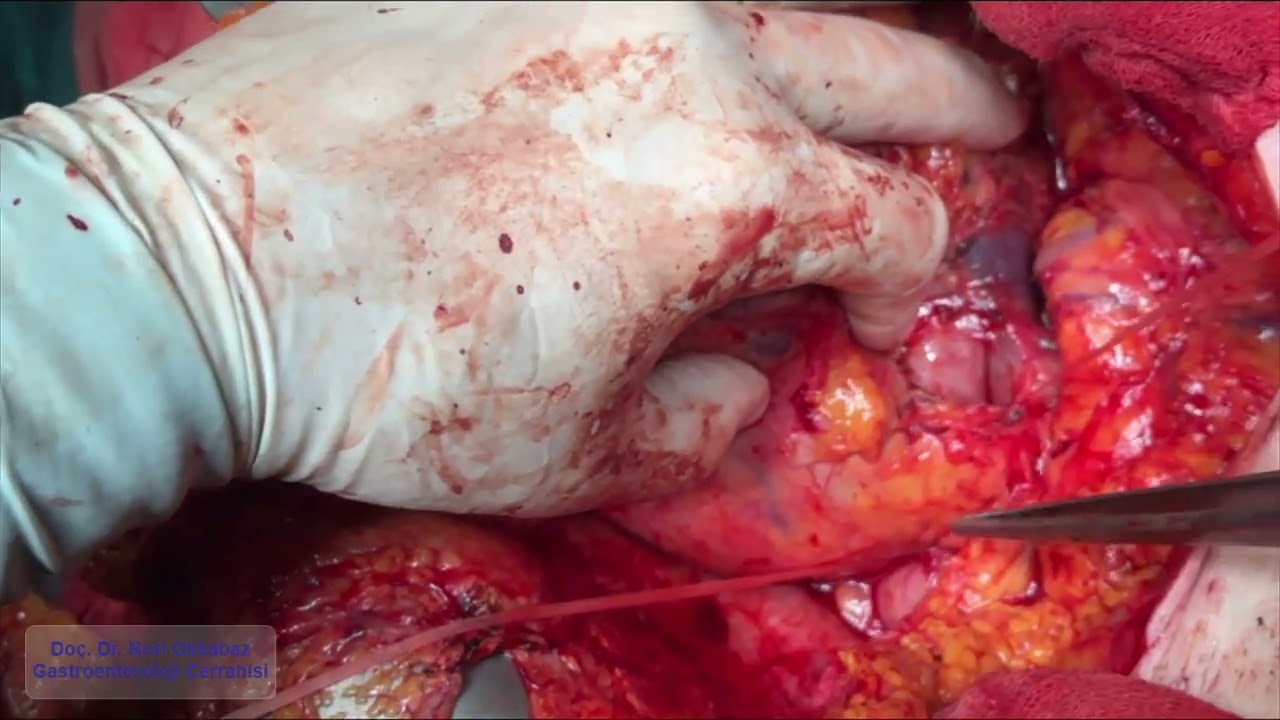 Surgical Resection of a Pancreatic Cyst