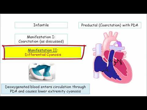 12DaysinMarch, Aortic Disorders (Part II) - Coarctation and Aortitis for USMLE Step One