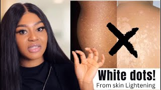 How to Get Rid Of White Spots | from using Skin Lightening products!