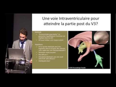 comment guerir une nevralgie pudendale