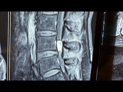 Life After Endoscopic Spine Surgery | Sancheti Hospital