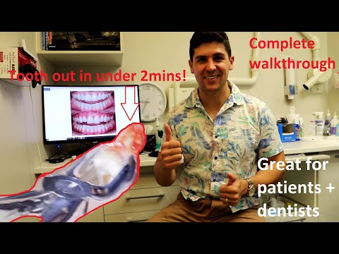 Upper Wisdom Tooth Extraction/Removal (Full Case Tutorial and Walk Through)