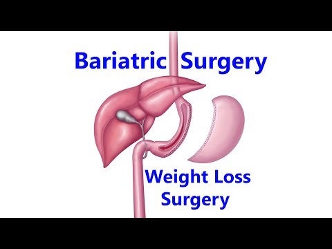 Bariatric Surgery for Weight Loss - Laparoscopic Sleeve Gastrectomy