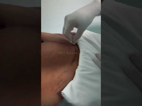 Testimonio: cuidado de la cicatriz