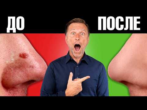 Вот ПОЭТОМУ вы не можете избавиться от акне и угревой сыпи😲 Вот ПОЭТОМУ вы не можете избавиться от акне и угревой сыпи😲