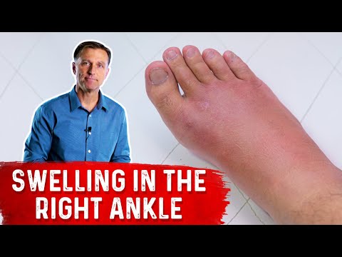 What Causes Right Ankle Edema?
