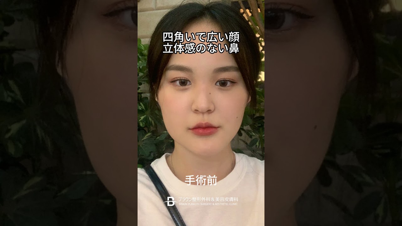 ビフォーアフター┃輪郭+鼻┃垢抜けるための1年間のダウンタイム ┃ブラウン整形外科┃#渡韓 #美容 #韓国整形 #シャクレ顎 #美容整形 #垢抜け #鼻整形 #鼻尖形成 #レポート #ダウンタイム