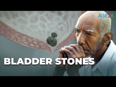 What Are Bladder Stones? Causes, Symptoms & Remedies