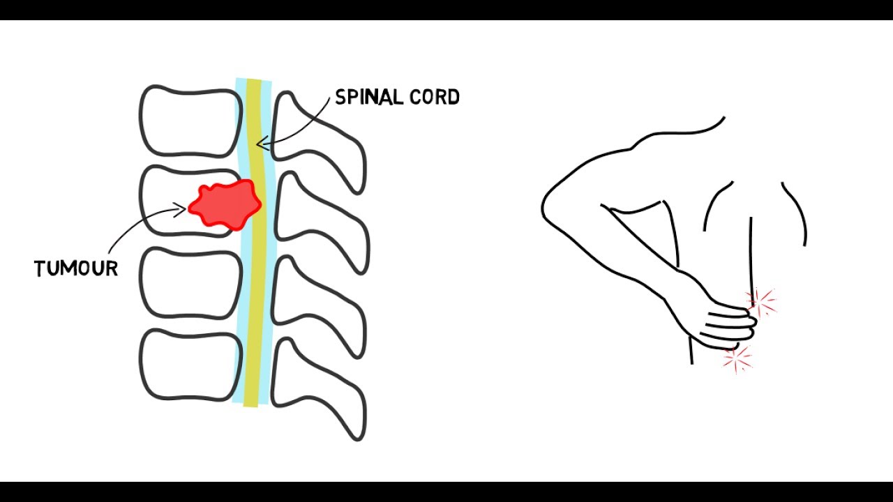 Spinal Cord Compression - YouTube