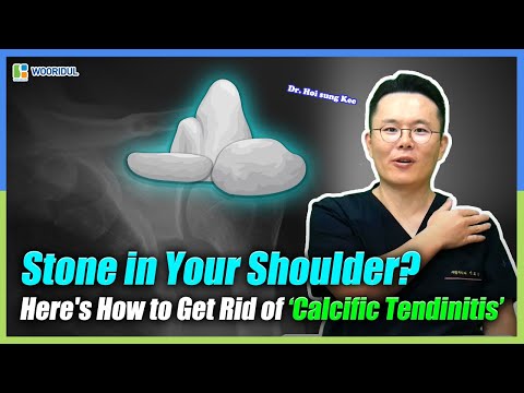 Calcific Tendinitis: The Stone in Your Shoulder