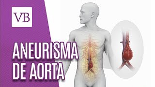 Mitos e verdades sobre Aneurisma de Aorta - Você Bonita (08/10/18)