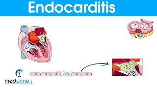 Endocarditis : causes, symptoms, pathophysiology, diagnosis and treatment