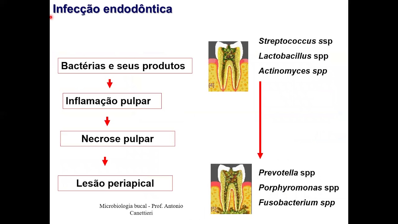 MICROBIOLOGIA BUCAL - Microbiologia das infecções pulpares e periapicais