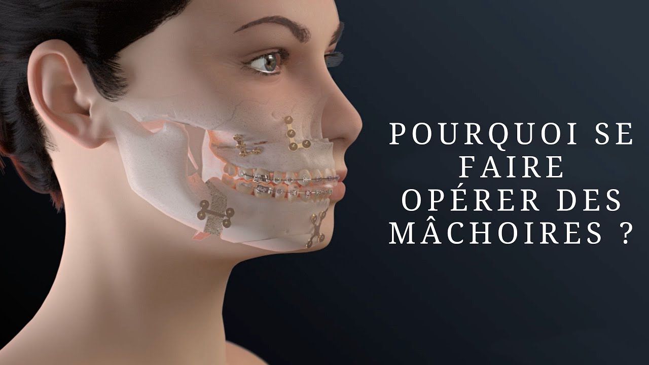 Pourquoi se faire opérer des mâchoires 