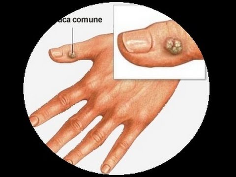 Lato dolente destro sulla parte superiore e posteriore Come il farmaco a ridurre linfiammazione in ginocchio