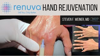 Renuva Hand Rejuvenation/Volumization - Dr. Steven F. Weiner