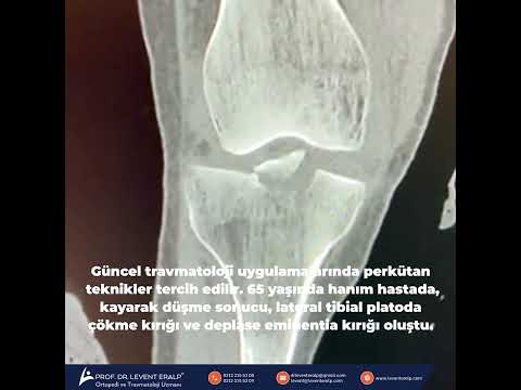 Güncel travmatoloji uygulamalarında perkütan teknikler tercih edilir