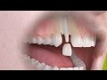Straumann - Traitement céramique d'une seule dent implanto-portée