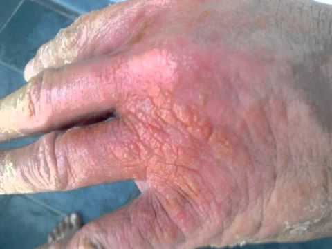 comment soigner eczema pied