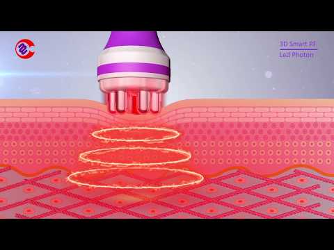 How Does RF Radio Frequency Facial Skin Tightening Work?