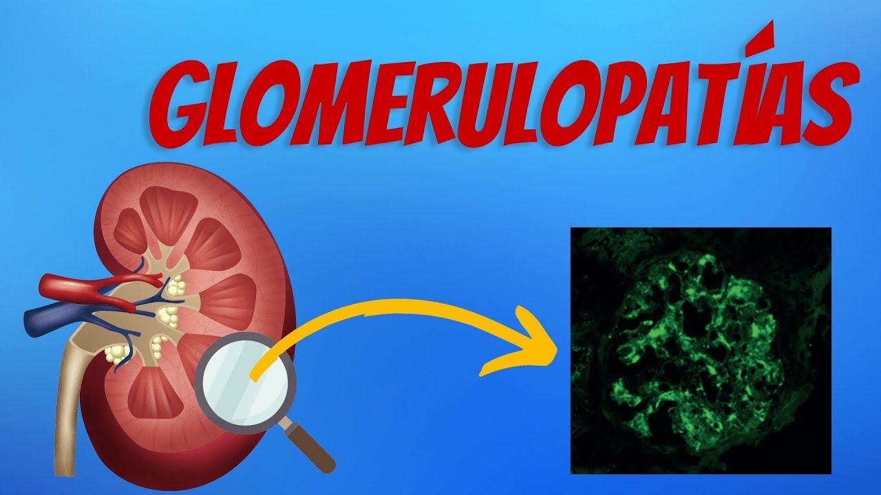 Glomerulopatías Explicadas Claramente