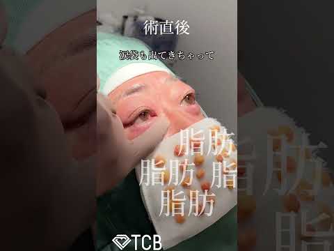 レンズ駅 - 定義