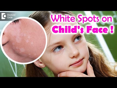 5 Things to know if your child is suffering from Pityriasis Alba? - Dr. Divya Sharma|Doctors' Circle