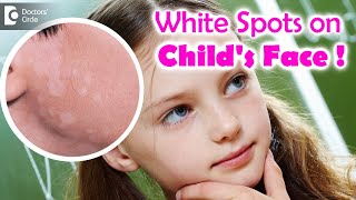 5 Things to know if your child is suffering from Pityriasis Alba? - Dr. Divya Sharma|Doctors