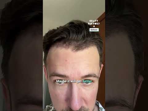 I regret my hair transplant 😅