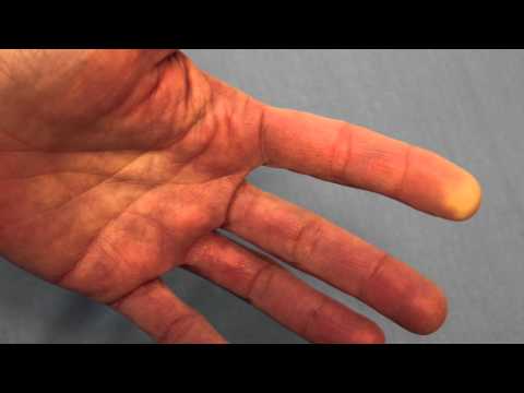 Raynaud's Phenomenon (Reduced Blood Flow) of the FIngertip