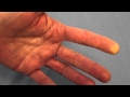 Raynaud's Phenomenon (Reduced Blood Flow) of the FIngertip