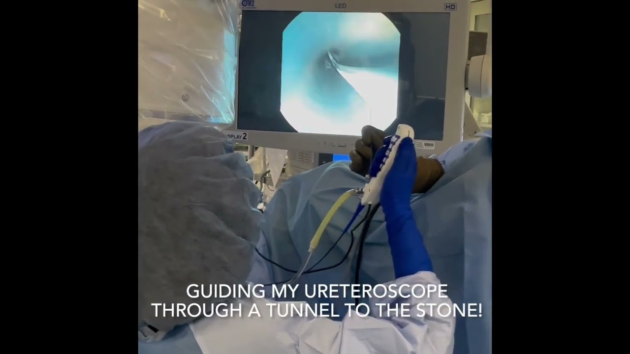 Ureteroscopy with Laser Lithotripsy | Treating Kidney Stones | Real Procedure Footage